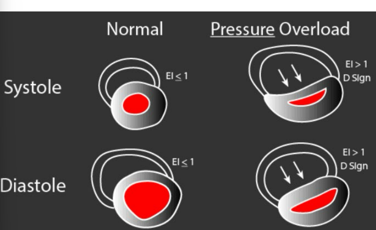 <p>D-shaped left ventricle evidenced during systole (particularly endsystole) suggests RV pressure overload</p>