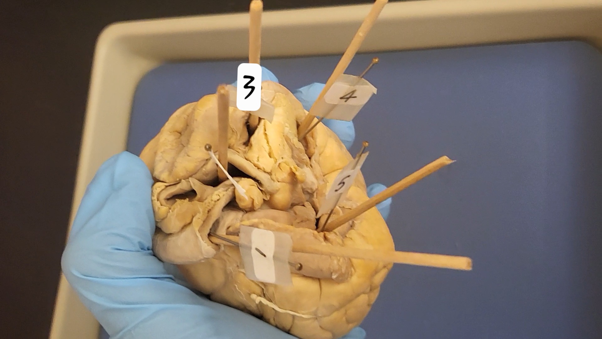 <p>Superior vena cava</p>
