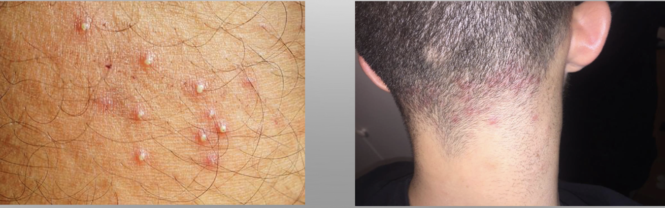 <p>bacterial: inflammation of the hair follicles</p><p>cause: staph bacteria; found in areas exposed to friction, moisture, rubbing, oil </p><p>symptoms: small pustule at hair follicle, mild redness, tender</p><p>treatment: topical antibiotic, chlorhexidine, warm saline compresses</p><p>no scarring, if extensive may have hair loss and systemic antibiotics, proper hygiene methods teaching </p>