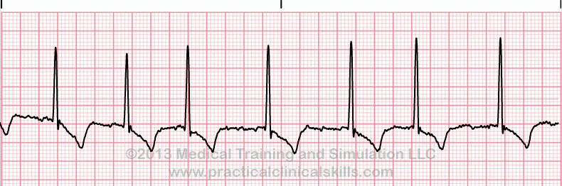 <p>No p-wave visible</p><ul><li><p>Replaced by rapind, chaotic fibrillatory (F) waves </p></li><li><p>Due to the chaotic, disorganized beating of the atria depolarization occurs</p></li></ul><p></p>