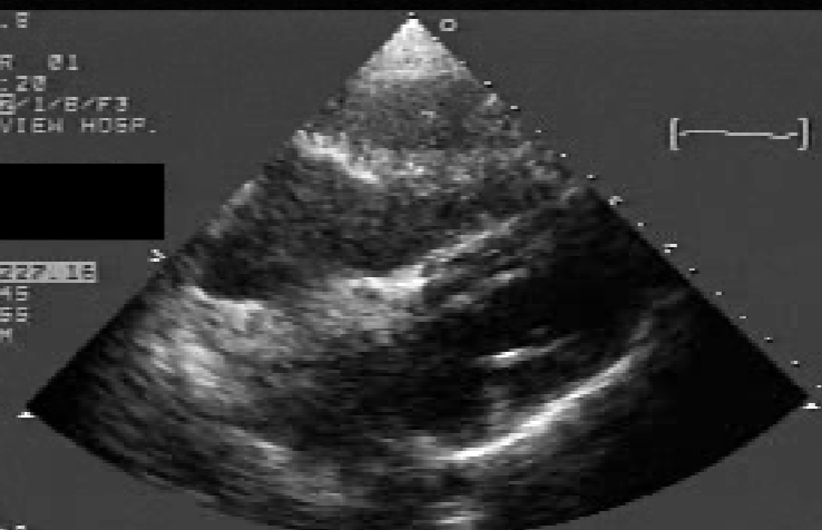 <ul><li><p><u>most common Lipoma location</u> is <span style="color: rgb(0, 132, 255);"><strong>IAS</strong></span></p></li><li><p><span style="color: red;">“Dumbell” shaped IAS</span></p><ul><li><p>d/t IAS thickening w/ sparing of fossa ovalis</p></li></ul></li><li><p>may cause A-fib</p></li><li><p>associated w/ <span style="color: rgb(144, 0, 255);">steroid use</span></p></li></ul><p></p>