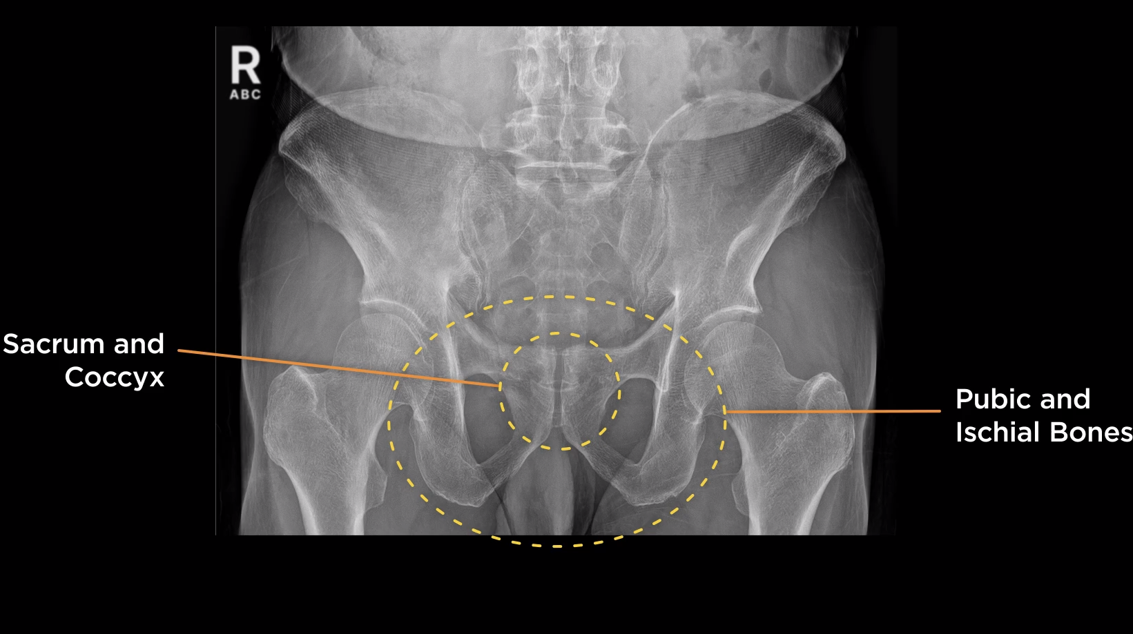 <p>AP Pelvis Inlet or Outlet?</p>