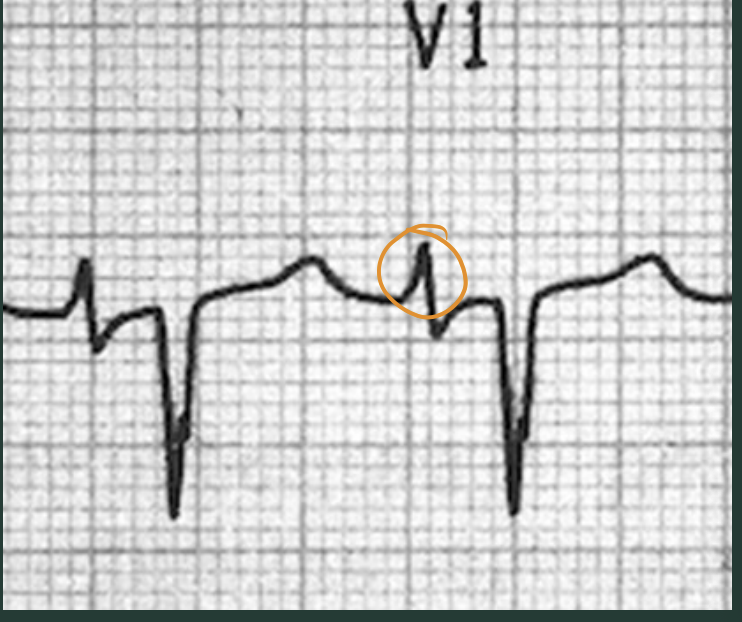 <p>What type of hypertrophy?</p>