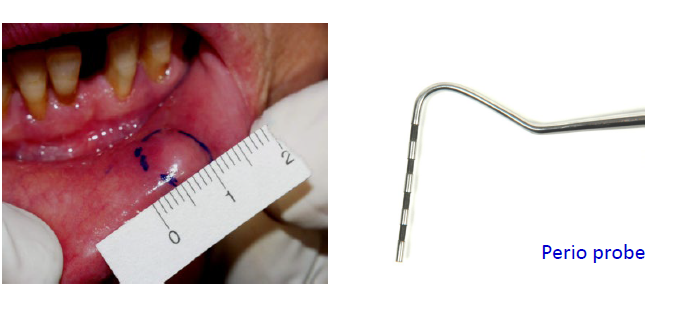 <ul><li><p>record the dimensions of the lesion in mm or cm (don’t say small or large as they are too vague)</p></li><li><p>intraoral: use perio probe as ruler</p></li><li><p>extraoral: use flexible rulers </p></li></ul><p></p>