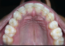 <p>Does splinting induces periodontal regeneration?</p>