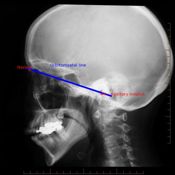 <p>defined by inferior <span>margin of orbit & superior margin of</span><br><span>the external acoustic meatus (EAM)</span></p>