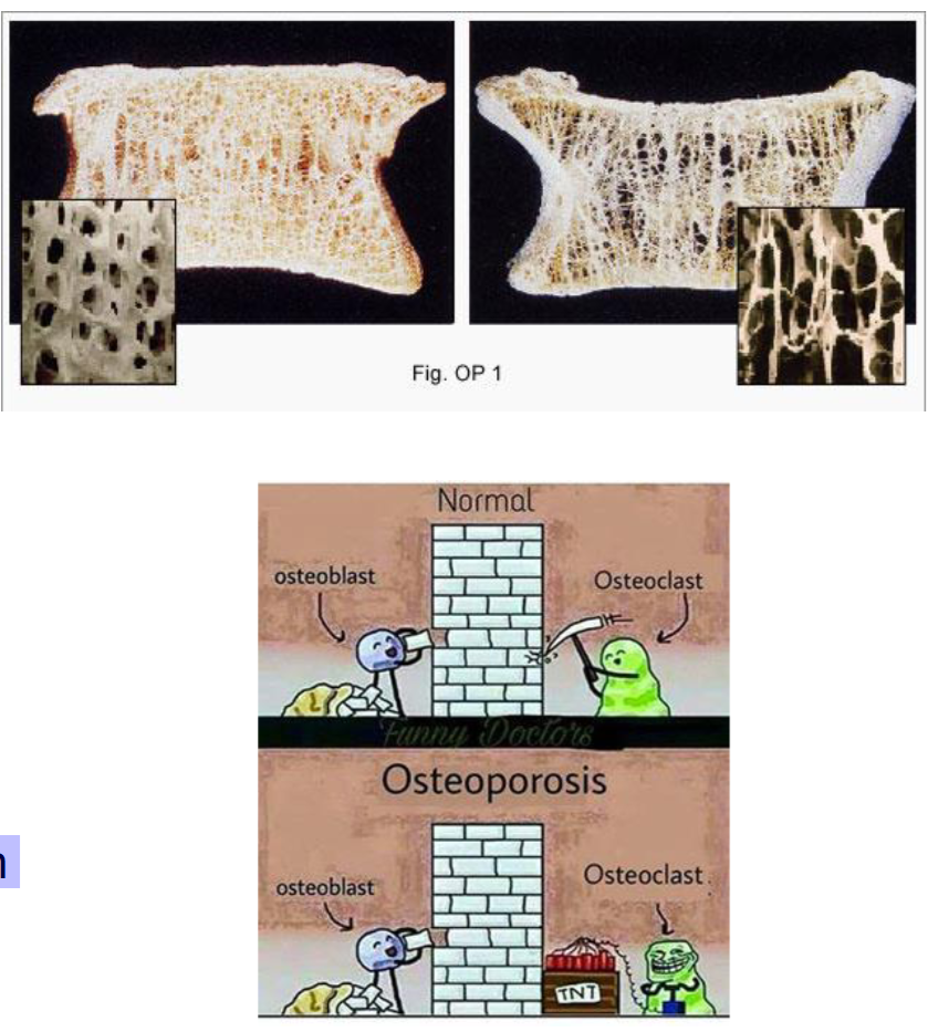 <p>Pathology: Metabolic Diseases Example: Osteoporosis</p>