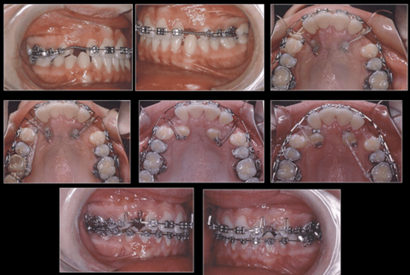 <p>This shows treatment of a maxillary impacted canine with what type of spring?</p>