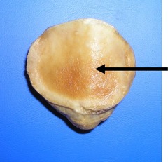 <p>Which surface of patella?</p>