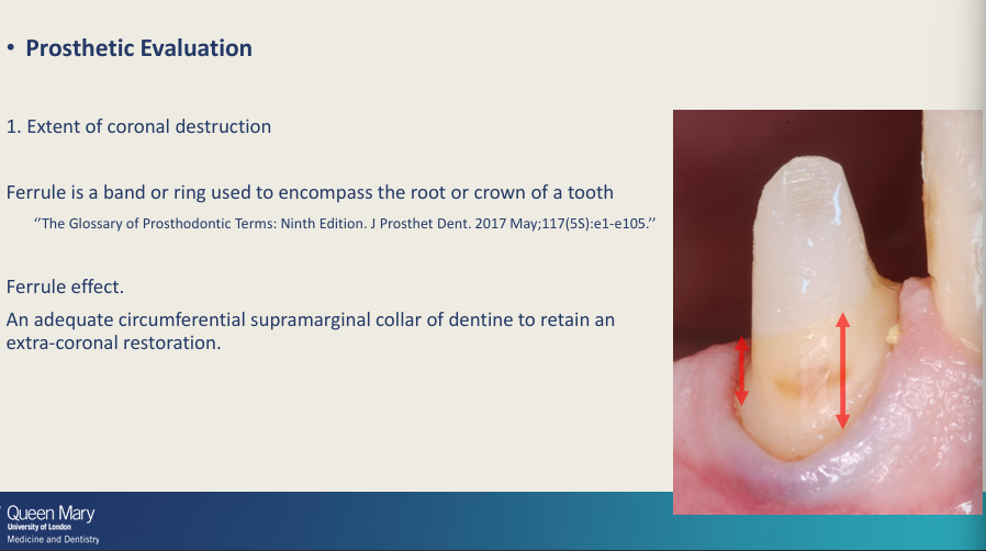 <ul><li><p>Extent of coronal destruction - Ferrule effect (a band or ring that encompasses the root or crown of a tooth)</p></li><li><p>Adequate circumferential supragingival collar of dentine to retain an extra-coronal restoration </p></li></ul><p></p>