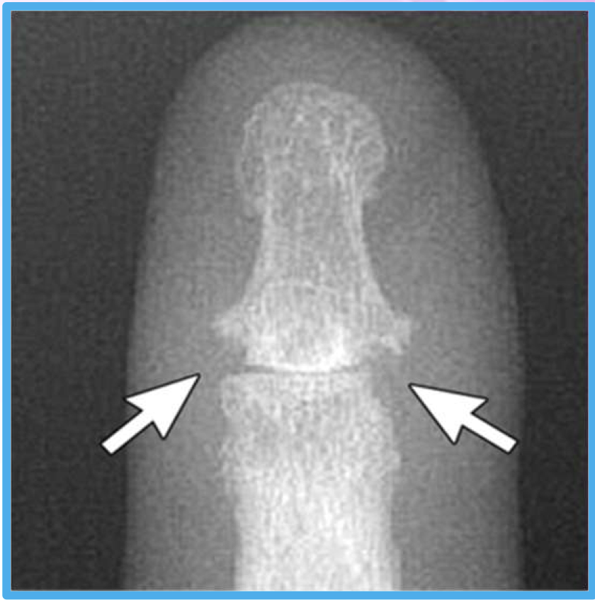 <p>What two findings of PsA are found in this image</p>