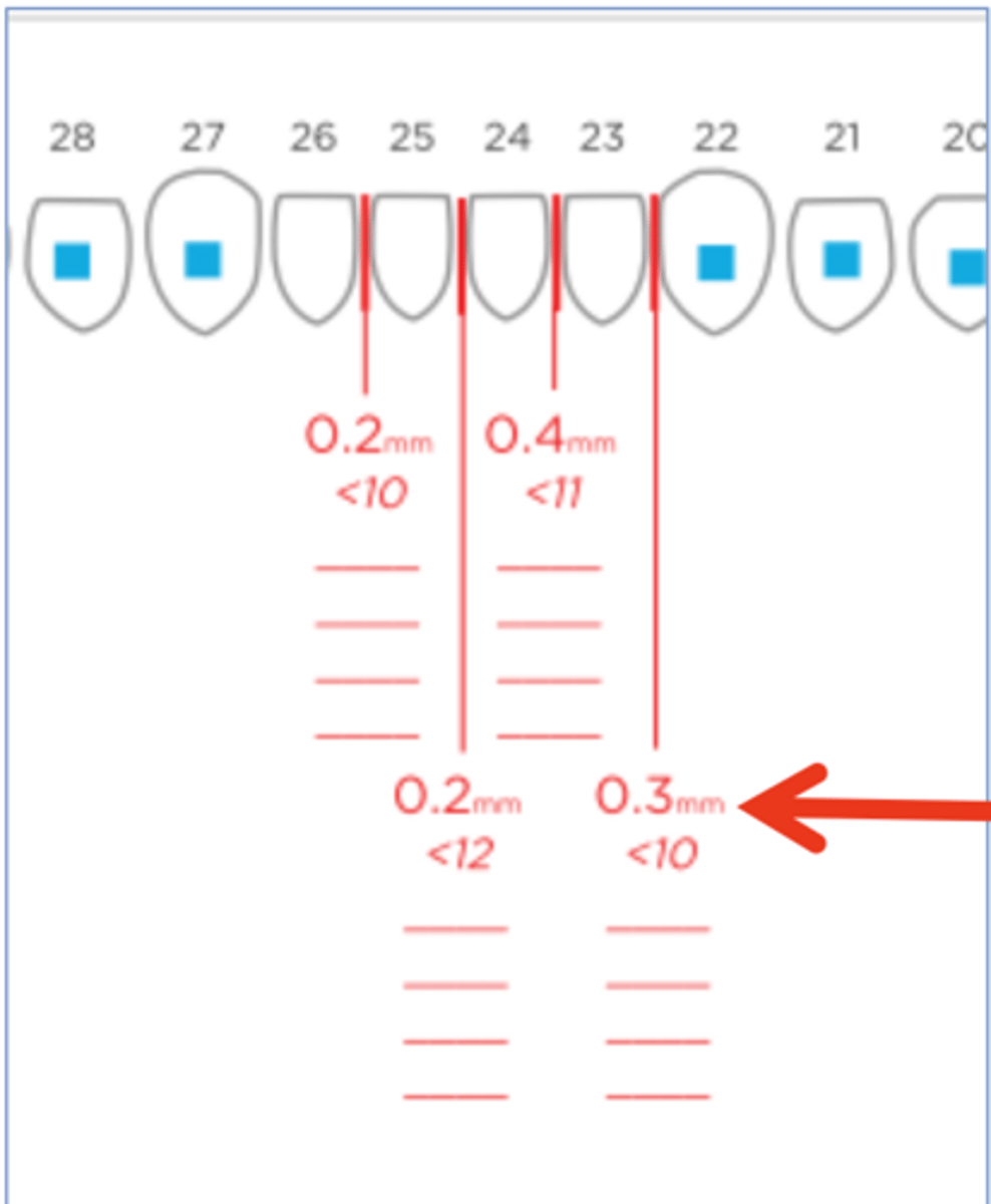 <p>What does this interproximal reduction (IPR) instruction mean?</p>