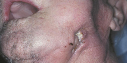 <p>manifestation of osteoradionecrosis </p>