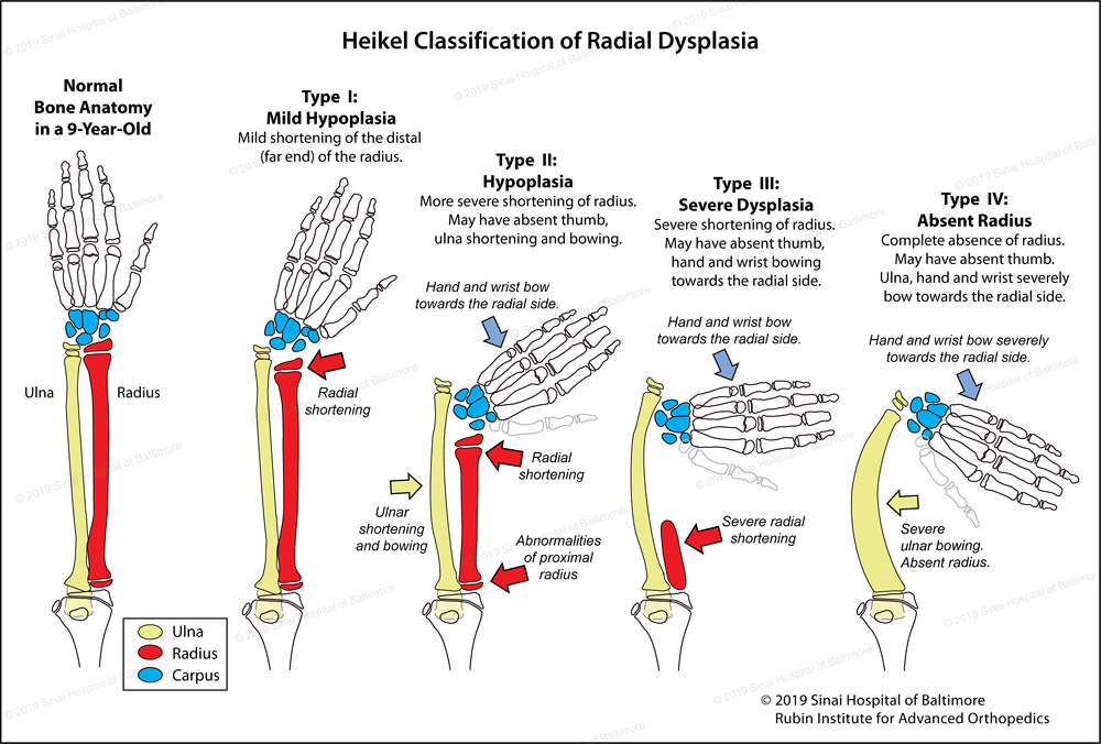 <p>Radial dysplasia / radial hypoplasia / club hand</p>