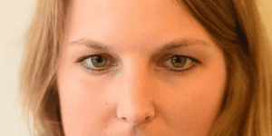 <p>Upper Lid Raiser</p>