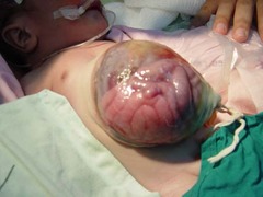 <p>Defect in the midline.</p><p>Covered by sac. </p><p>- Assoc w/ other disorders?</p>