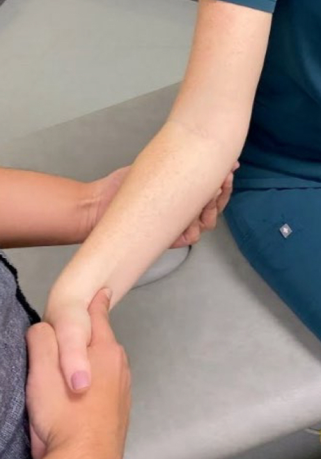 <ol><li><p>tell pt to do active forearm pronation and supination</p></li><li><p>ballerina pose (arms go overhead)</p></li><li><p>is there’s a side that’s bothering you?</p></li><li><p>Feel for both medial and lateral olecranon process.</p></li><li><p>Two-hand hold possible OR place thenar/hypothenar on one end then cup using fingers while other hand grabs wrist rather than hand instead.</p></li><li><p>Naturally elbow should be 5-45°</p></li><li><p>Test for ROM (Abduct, adduct, flex, extend)</p></li><li><p>greater angle with carrying position = prefers aBduction</p></li></ol><ul><li><p>aBduction SD = arm is more angulated = increased carrying angle. </p></li></ul><ul><li><p>aDduction SD = arm appears straighter = decreasing the carrying angle (producing a “gunstock deformity”).</p></li></ul><p></p>