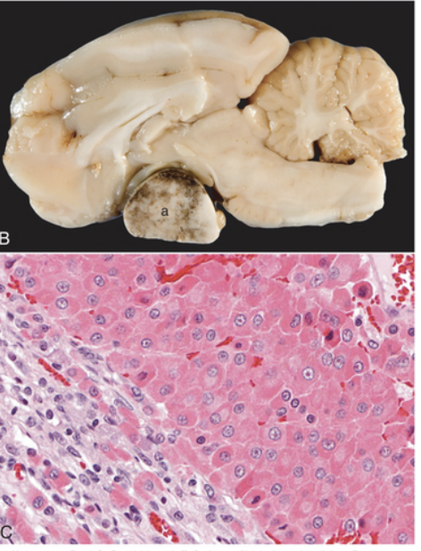 <p><strong>Du obducerar en katt som uppvisar förstorade njurar, lever och hjärta, ett brett ansikte och stora tassar. Du finner</strong></p><p class="p1"><strong>en neoplasi i hypofysen med proliferation av acidofila celler i pars distalis (se bilder nedan).</strong></p><p class="p1"><strong>a) </strong>Vilket sjukdomstillstånd misstänker du baserat på makro- och mikroskopiska fynd? <strong>(1p)</strong></p>