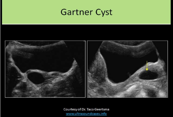<p>A. Gartner cyst</p><p>A Gartner cyst is a cyst that forms in relation to the Gartner ducts in the vagina</p>
