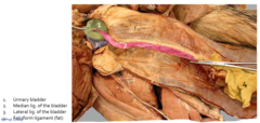 <p>1. ventrolateral abdominal mm. </p><p>2. falciform ligament</p><p>3. median ligament of the bladder</p>
