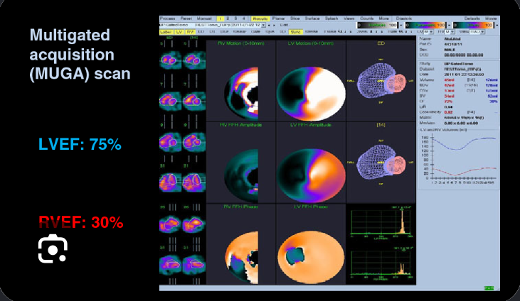 <p><strong>Radionuclide imaging. (Evaluation of resting regional and global function)</strong></p><p></p><p><strong>MUGA</strong> is a type of <strong>radionuclide imaging</strong>, meaning it uses a <strong>small amount of radioactive tracer</strong> to take pictures of the heart.</p><p><strong>MUGA = Multiple Gated Acquisition scan</strong></p><p>Very simply:</p><p><strong>radioactive tracer → camera tracks it in the blood → pictures show how the ventricles pump</strong></p>