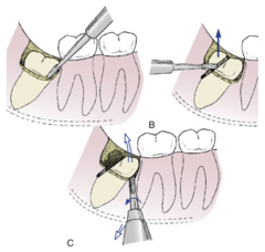 <p>You would use this procedure to extract a ________:</p><p>- Buccodistal bone is removed to expose the crown of the tooth to the cervical line</p><p>- Distal aspect of the crown is then sectioned from the tooth</p><p>- May be necessary to section the entire tooth into two portions rather than to section the distal portion of the crown only</p><p>- Distal portion of the crown has been delivered small straight elevator inserted into the surgically exposed mesial aspect of the crown to deliver the remainder of the tooth as shown.</p>
