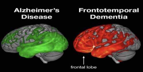 <p>Frontotemporal Dementia (FTD)</p>