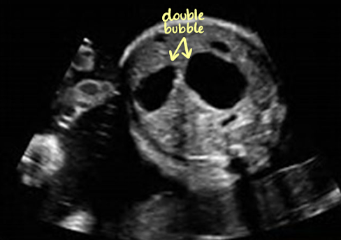 <ul><li><p><span style="color: red;">double bubble sign</span></p><ul><li><p>dilated stomach and duodenum </p></li></ul></li><li><p>polyhydramnios</p></li><li><p>AC will be large</p></li></ul><p></p>