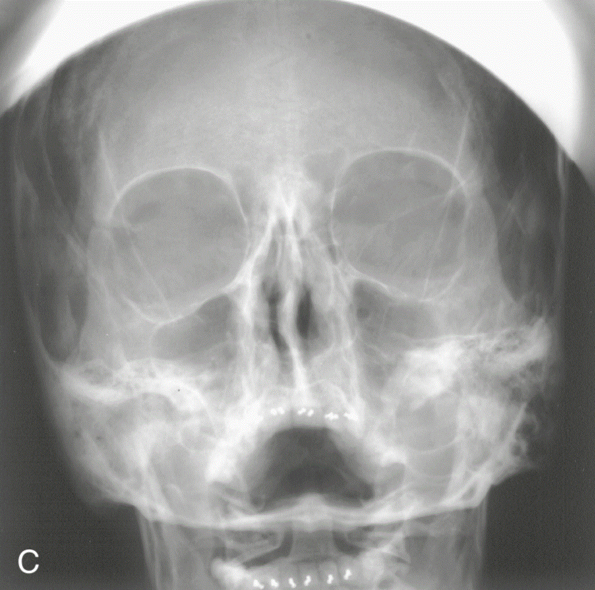 <p>In this image, Water's projection, what action could the technologist take to correct the positioning error?</p>