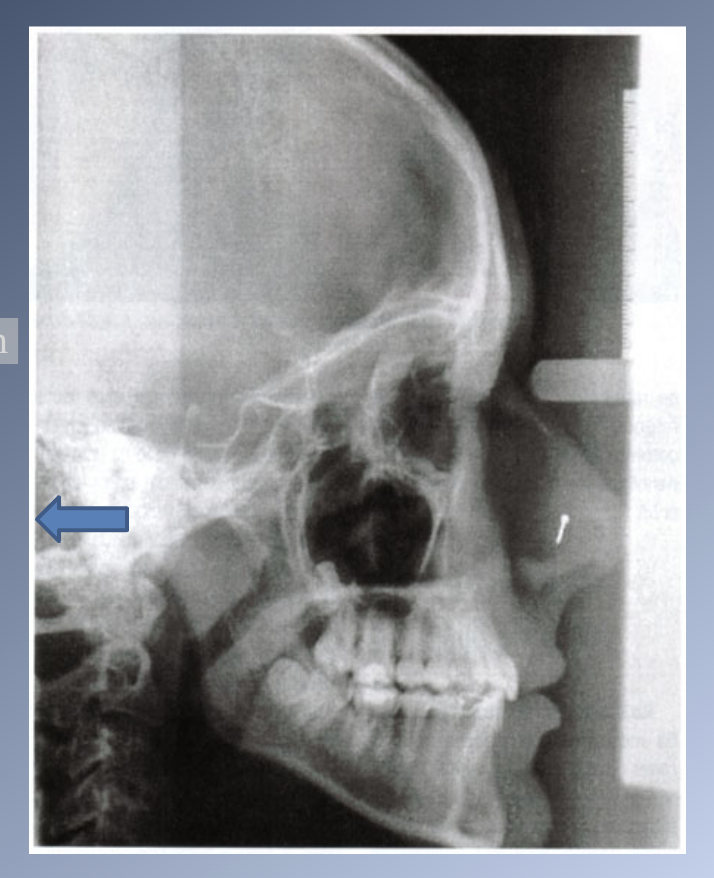 <p>MATURATIONAL AND AGING CHANGES- LATE MANDIBULAR GROWTH-2</p>