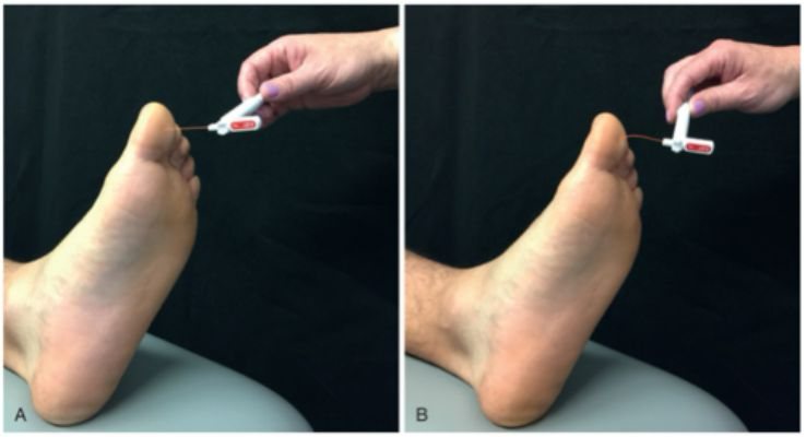 <p>"</p><ul><li><p><strong>Monofilament Testing</strong> </p><ul><li><p>Done with a 5.07 monofilament (differing for different areas of the body)</p></li><li><p>Mostly done on the feet</p><ul><li><p>Because the feet are very important with gait and balance</p></li></ul></li></ul></li><li><p>You put the<strong> monofilament on different spots on the foot</strong> as see if they detect pressure</p><ul><li><p>Pressure should be applied enough to bend the filament</p></li></ul></li><li><p><strong>Five trials</strong> should be completed at each site (the order DOES NOT matter)</p><ul><li><p>4/5 is adequate (or 2/3 if you do not have enough time to perform 5 trials)</p></li></ul></li><li><p><strong>Commonly used for Diabetic Neuropathy</strong> </p><ul><li><p>We can often be the first person to catch someone developing diabetes</p></li><li><p>Patients often report changes in sensation (N&T)</p></li></ul></li></ul><p></p>