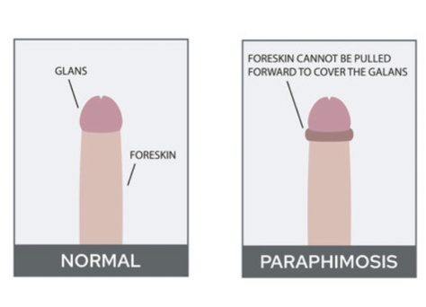 <p>when the foreskin has been retracted behind the glans penis and cannot be returned to its normal position</p><ul><li><p>results in swelling that traps the foreskin behind the glans.</p></li></ul><p></p>