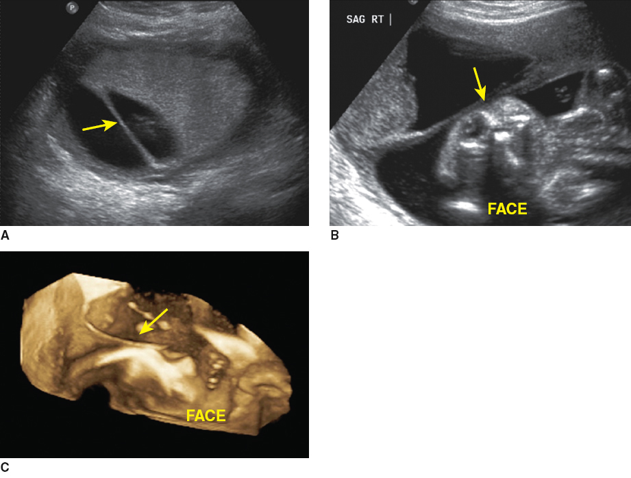 <p>uterine synechiae; which may be recognized as linear, thin membranes with a broad base crossing the amniotic sac</p>