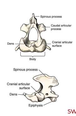 <p>Q: The axis (C2) features the presence of the dens, which is also called the …… </p><p>A. mamillary process </p><p>B. odontoid process </p><p>C. accessory process </p><p>D. spinous process</p>