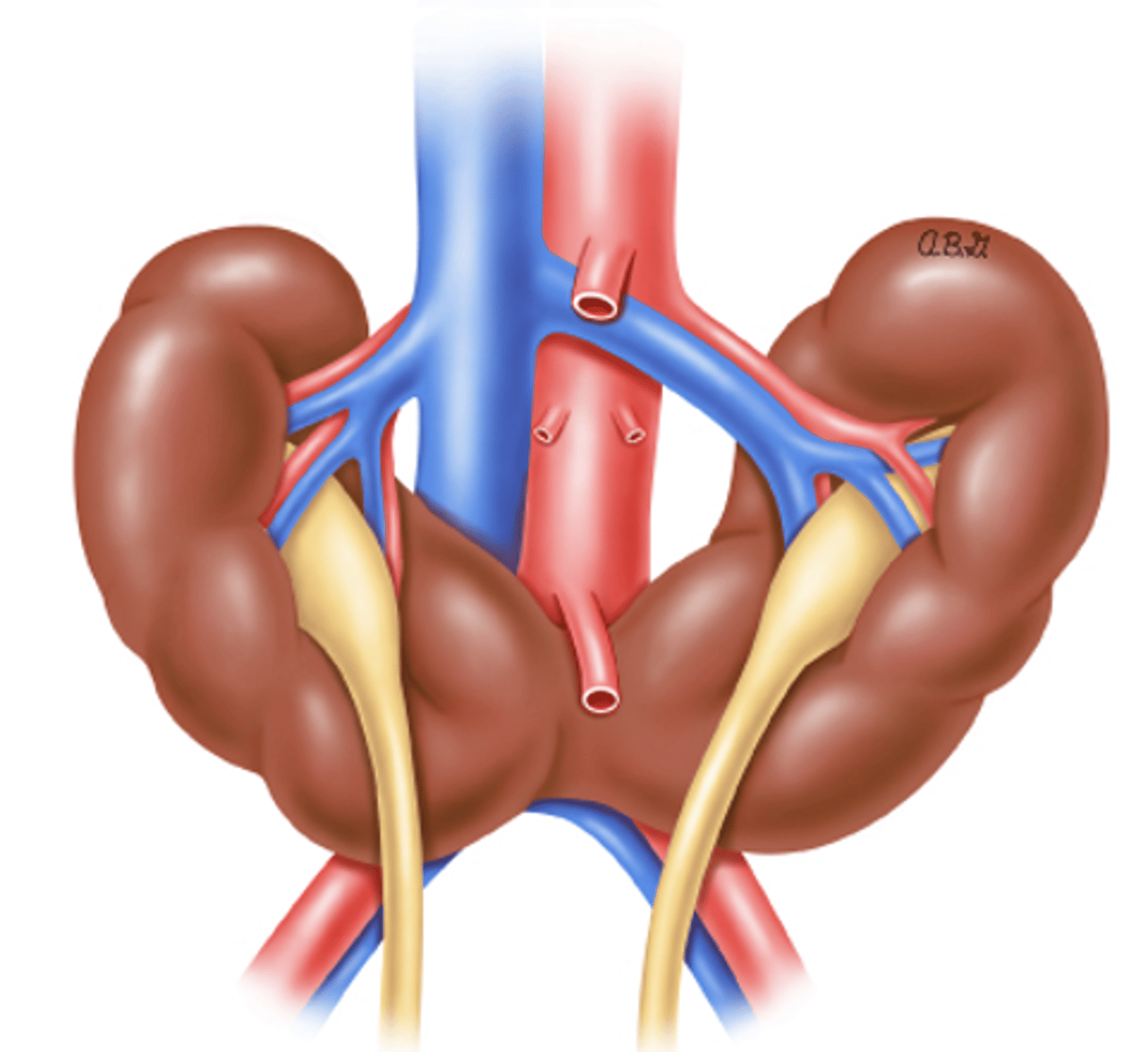 <p>MC renal fusion anomaly that occurs at lower poles and disrupts normal rotation and ascent</p>