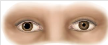 <p>Pupil is unilat large, with slow/absent reaction to light, and slow tonic constriction during near vision due to parasyp DEnervation<br>Slow accommmodation → blurred vision</p>