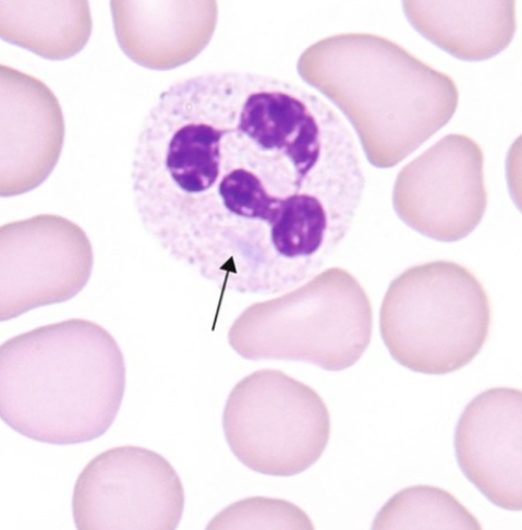 <p>Pale blue, round/oval/rod shaped RNA inclusions, found in neutrophils and eosinophils, often seen with toxic granulation and May-Hegglin, and seen in bacterial infection, burns, cancer</p>