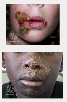 <p>Characterized by pustules and honey-coloured crusted erosions.</p><p>Secondary infection of wounds or other skin lesions with the same pathogens is called ‘impetiginization’. </p><p>Classified into non-bullous (starts with one lesion, limited erythema, lesions burst and form honey colored crust, patients generally feel well) and bullous impetigo (quick bullae formation, ruptures and oozes yellow fluid, systemic symptoms may be present)</p>