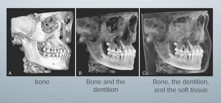 <p>-often accomplished by an adjustable scale determining the upper and lower limits and range of intensity values to include in the segmentation</p><p>-visual result of changes in this scale is displayed in “real-time” to visualize the effects of incremental changes</p><p>-segmentation may be optimized to reveal the objects of interest including A) bone as a solid surface or shaded surface display, B) bone and the dentition under the bone as a transparency using volumetric imaging, C) bone, the dentition, and the soft tissue surface using volumetric imaging</p>