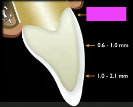 <p>How much enamel do you have apically?</p>