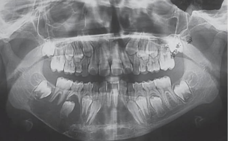 <p>A 9 year old boy presented with swelling of the lower face. Provide DD</p>