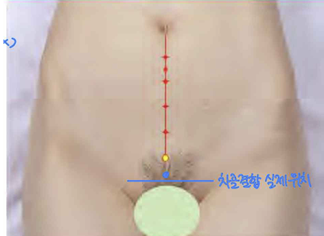 <p>앞정중선 위, 두덩결합 위 모서리</p>