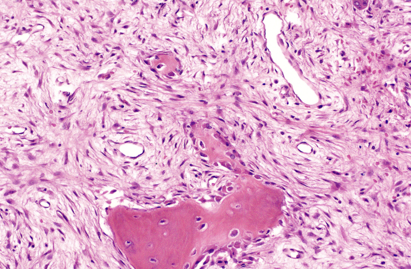 <p>tumeur tibia antérieur enfant</p><p>diagnostic</p><p>définition</p><p>age</p><p>topographie</p><p>anatomie</p><p>histologie</p><p>IHC </p><p>moléculaire</p><p></p>
