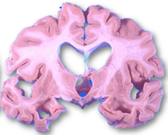 <p>What is hydrocephalus ex vacuo?</p>