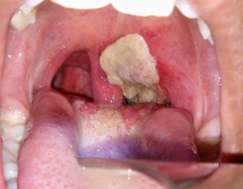 <p>affecting the nose, skin, and throat</p><p>acute infectious disease caused by <span style="color: red;">corynebacterium diphtheriae</span></p><p>white pseudomembrane formation, which can obstruct breathing (can extend into the trachea)</p>