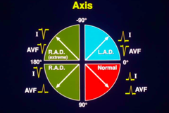 <p>lead I is right thumb and AvF is left thumb</p>