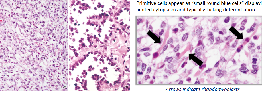 <ul><li><p>rhabdomyoma</p></li><li><p>rhabdomyosarcoma</p><ul><li><p>embryonal (head/neck mass) → <strong>primitive</strong> round (blue)/spindle</p></li><li><p>alveolar →<strong> FOXO1 + PAX3 t(2;13)</strong> or PAX7 t(1;13), myogenin immunostain</p></li><li><p>pleomorphic → eosinophilic cytoplasm</p></li><li><p>spindle cell/sclerosing</p></li></ul></li></ul><p></p>
