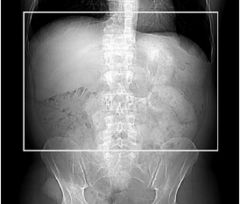 <p>Start location: Just above diaphragm End location: At iliac crest (include entire liver)</p>