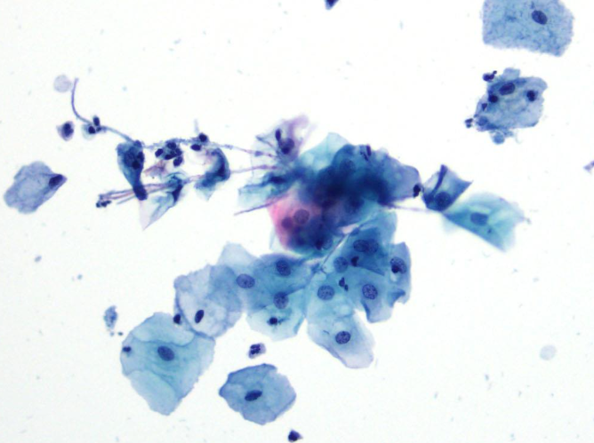 <p><span>What is the clinical finding depicted in the image typically associated with?</span></p>
