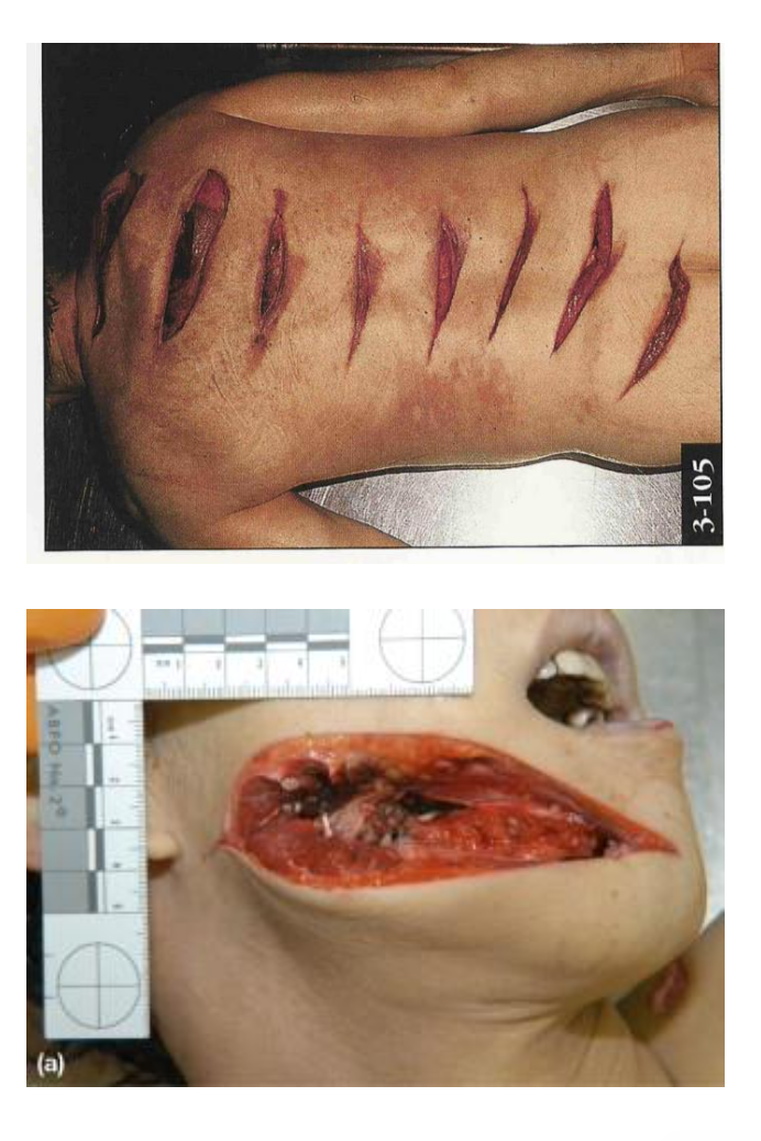 <p><strong>Chop injuries:</strong> wounds caused by <strong>heavy sharp-edged weapons</strong>, combining <strong>sharp force and blunt force trauma</strong>.</p><p class="isSelectedEnd"><strong>Common weapons:</strong></p><ul><li><p><strong>Axes, hatchets, machetes, swords</strong></p></li><li><p><strong>Boat propellers</strong> or other heavy sharp objects</p></li></ul><p class="isSelectedEnd"><strong>Key features:</strong></p><ul><li><p><strong>Deep soft tissue transections</strong> with <strong>smooth edges</strong></p></li><li><p>May show <strong>abrasion or bruising at wound margins</strong> due to blunt force</p></li><li><p>Often associated with <strong>underlying bone damage</strong></p></li><li><p><strong>Notch-like injuries in bone</strong> may be present</p></li></ul><p class="isSelectedEnd"><strong>Forensic point:</strong></p><ul><li><p>Injury reflects both <strong>cutting action and heavy impact force</strong>.</p></li></ul><p></p>